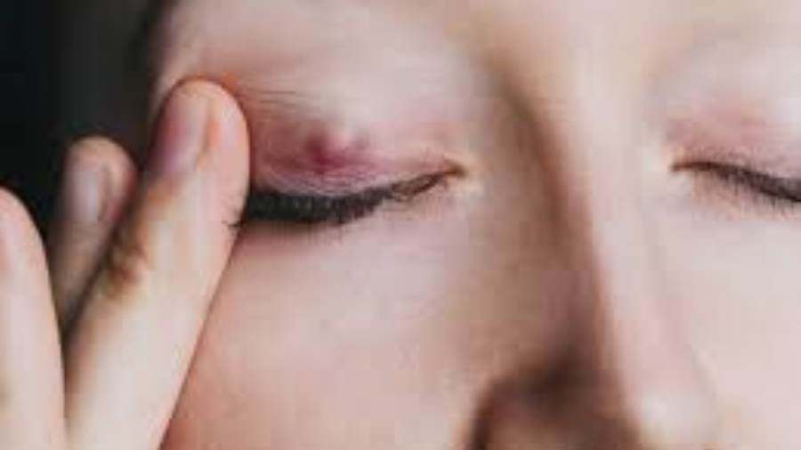 اعراض الكيس الدهني في العين - vayp-por