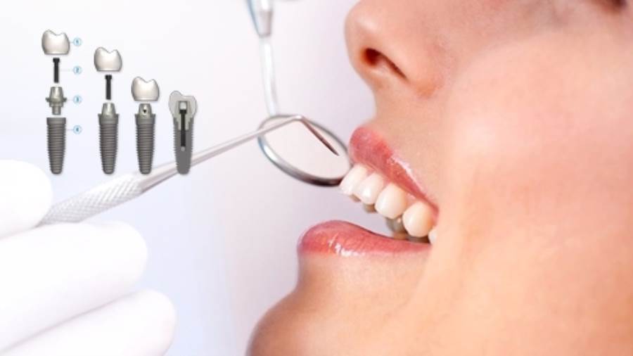 Doctor live | زراعة الأسنان الفورية .. اختر زرعتك سويسري أو ألماني أو كوري