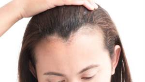 التهاب المنطقة المانحة بعد زراعة الشعر