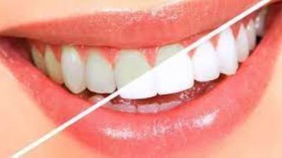 طرق تبييض الأسنان عند الطبيب بالتقنيات الحديثة