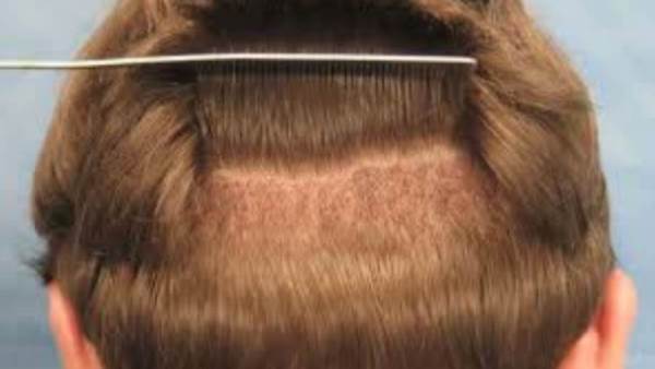 How does hair transplantation become a very comfortable experience